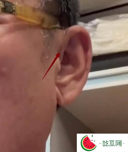 李立群耳朵戴的那根线是什么东西？隐形助听器的线