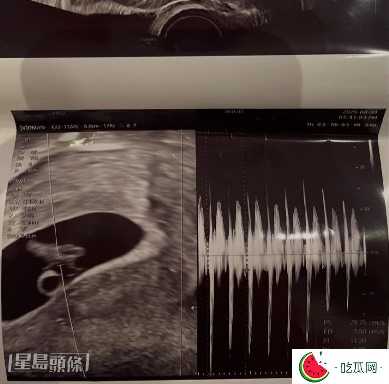 徐敏在于IG大晒胎儿超声波照，宣布怀孕。